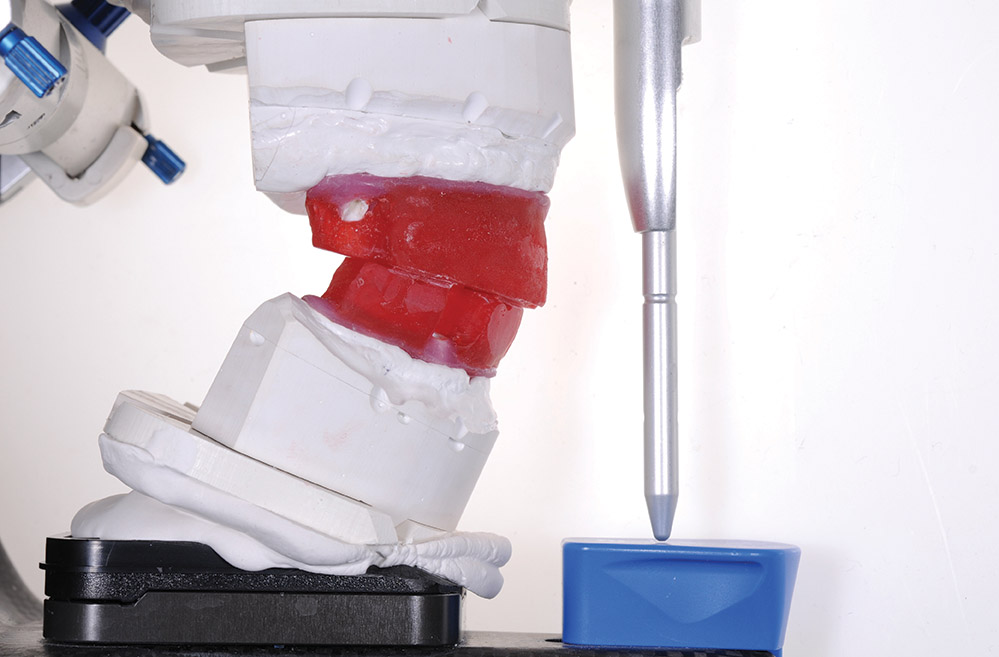 What to Choose: Conventional Methods or CAD/CAM | Inside Dental Technology